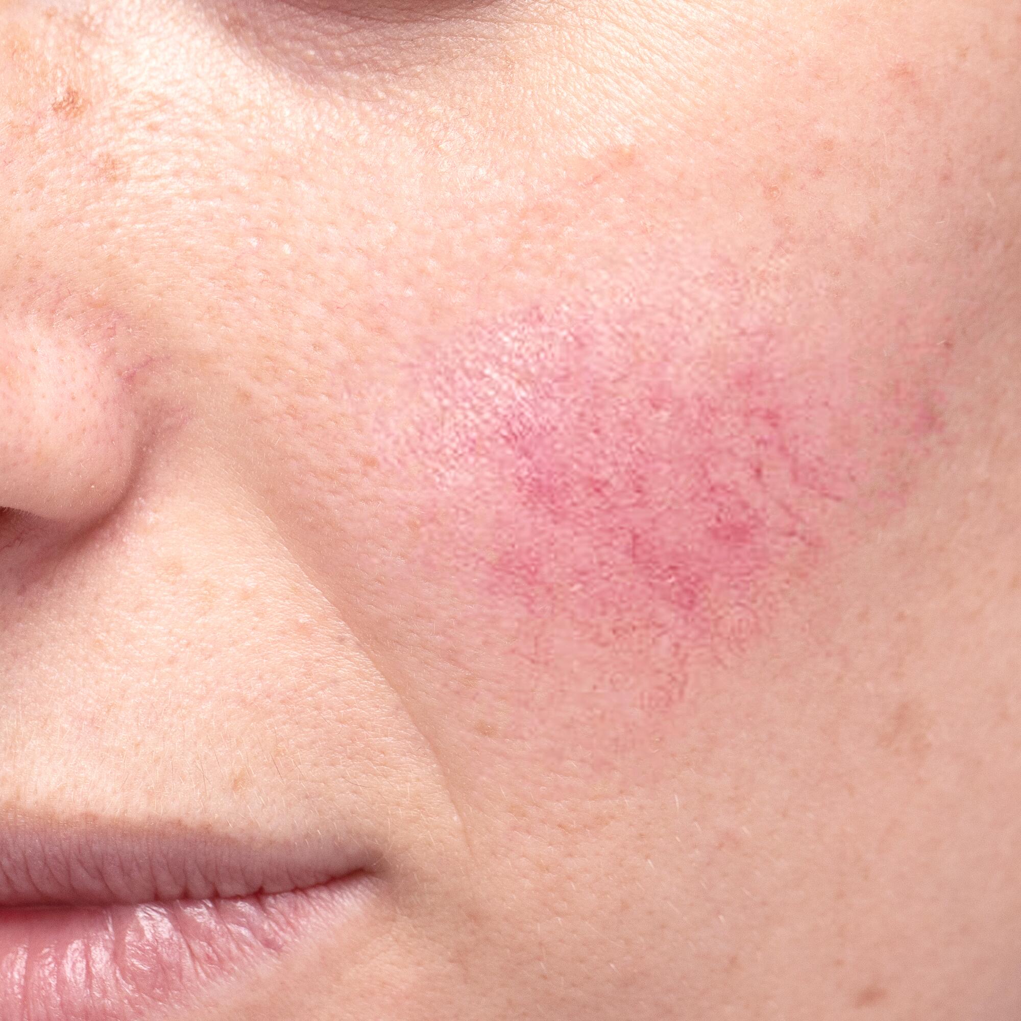 Nærbilde av ansikt med tydelig rødhet på kinnet, typisk for rosacea og hud som kan ha behov for krem mot rødhet
